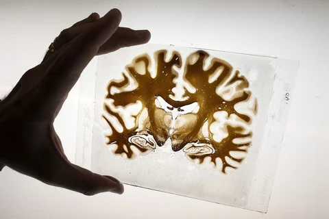 A sliced section of a human brain is displayed for a photograph. (Photographer: David Paul Morris/The Brain Observatory/Bloomberg)