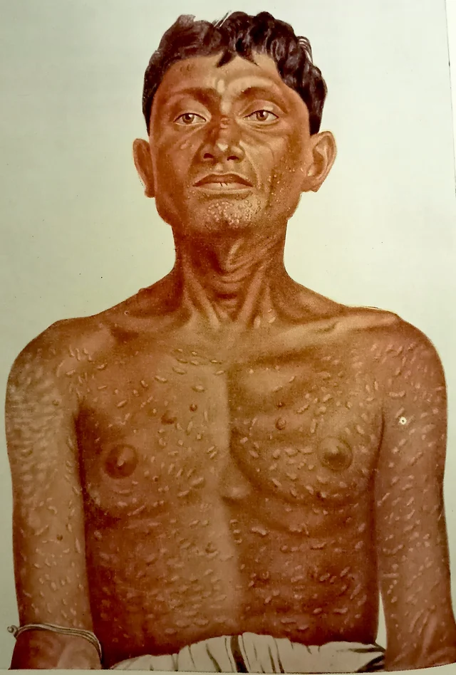 Figure 5. Brahmachari’s Dermal Leishmaniasis (From ‘Gleanings From My Researches’, by Upendranath Brahmachari, Calcutta University Press, 1940)