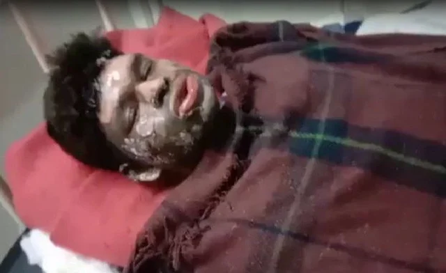 Dhan Prasad after the alleged attack.