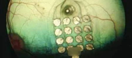 Eye implant helps blind patients 'read' Braille