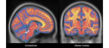 Karate black belts have different brains