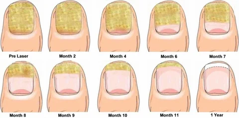 Fungal Nail Infections