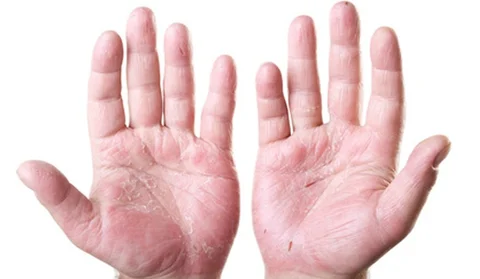 Psoriasis