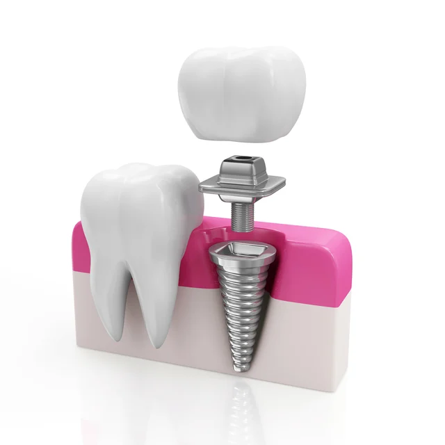 What is Dental Implant?