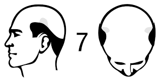 Can A Hair Transplant Always Provide 100% Coverage For The Balding and Receding Parts?