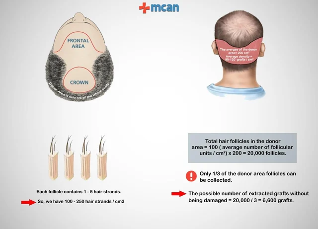 Can A Hair Transplant Always Provide 100% Coverage For The Balding and Receding Parts?