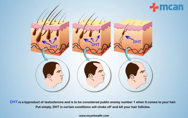 Can A Hair Transplant Always Provide 100% Coverage For The Balding and Receding Parts?