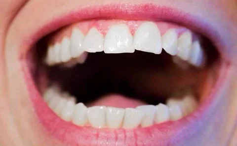 What Do You Do When Your Dental Implants Start Falling Out