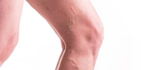 Varicose Veins