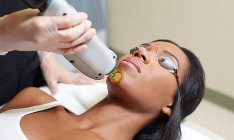 Laser hair removal: the answers to your questions