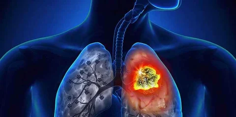 Risk of Lung Cancer