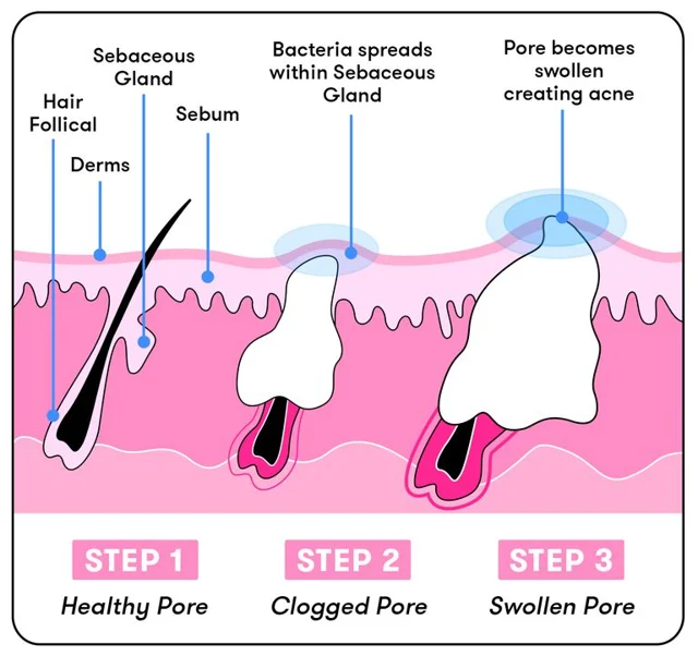 How to Get Rid of Severe Acne?