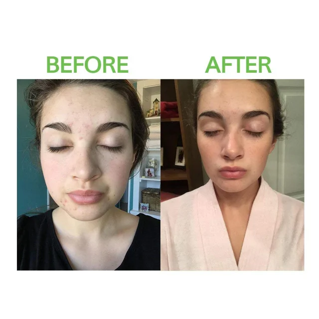 How to Get Rid of Severe Acne?