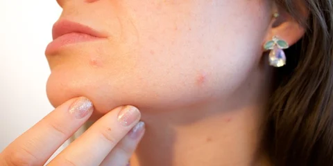 How to Get Rid of Severe Acne?