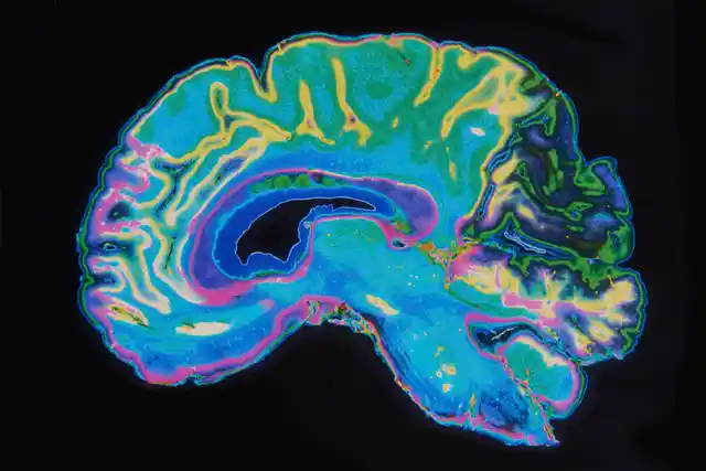Brain scan of an Alzheimer’s patient (Photo: iStock)