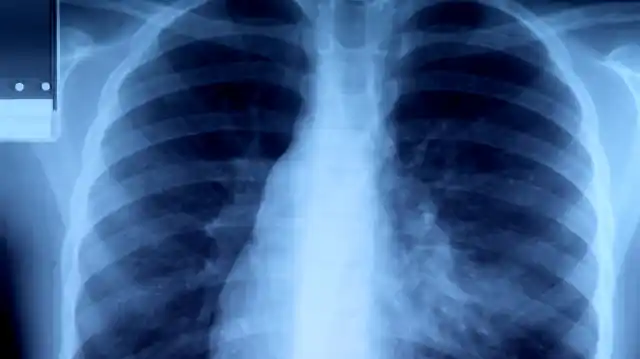 Impact of air pollution on health has also been understudied in Delhi, with little epidemiological evidence available on the same. (Photo: iStock)