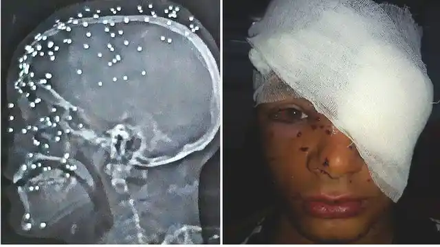 (Photo Courtesy: Facebook/<a href="https://www.facebook.com/kashmirscarsofpelletgun/?fref=ts">Kashmir Scars of Pellet Guns</a>)