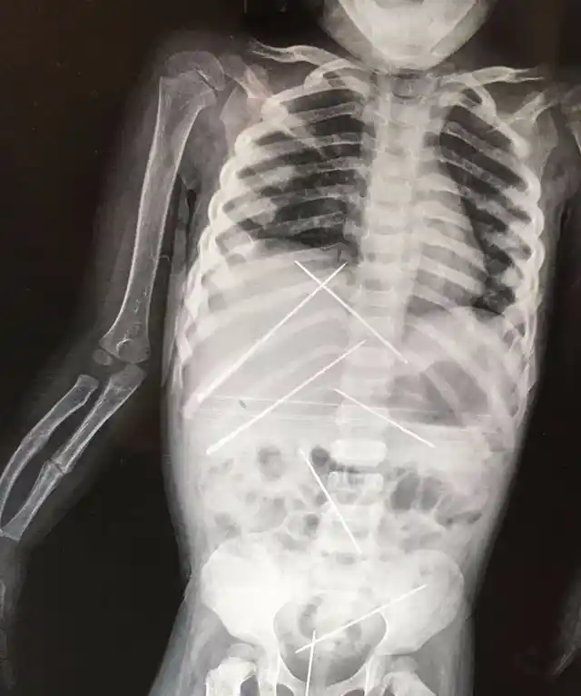 X-ray of the three-year-old shows needles inside her body.