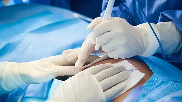 Surgery is generally advised to be conducted among patients suffering from spinal cord compression caused by metastatic cancer.