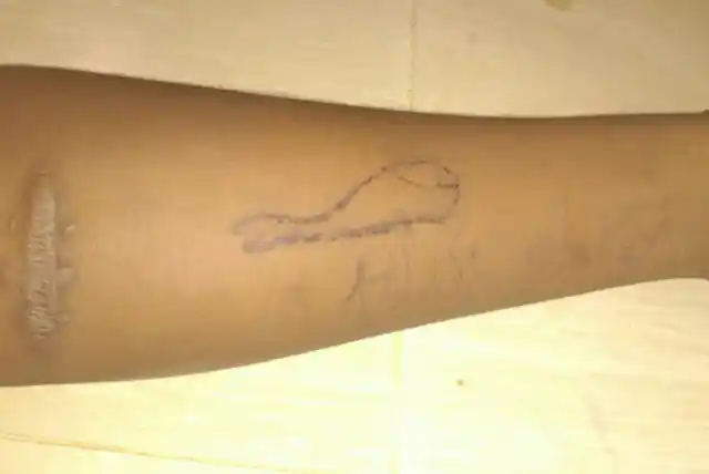 The forearm of the teenager raised suspicion over his involvement in the deadly Blue Whale challenge.