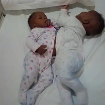 Six-month-old siamese twins from Nigeria, James and John, who were separated at a private hospital in Bengaluru.