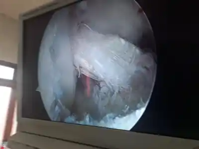 Arthoscopy being performed Udhampur district hospital by senior Orthopedic surgeon Dr Balvinder Singh and team.