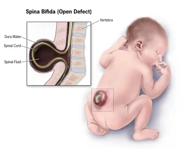 A child with spina bifida.