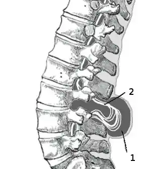 Illustration of Meningomyelocele.