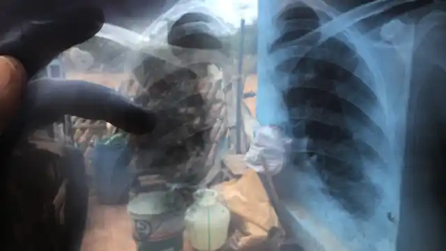 Finding cancer patients wasn’t too difficult in villages near Sterlite.