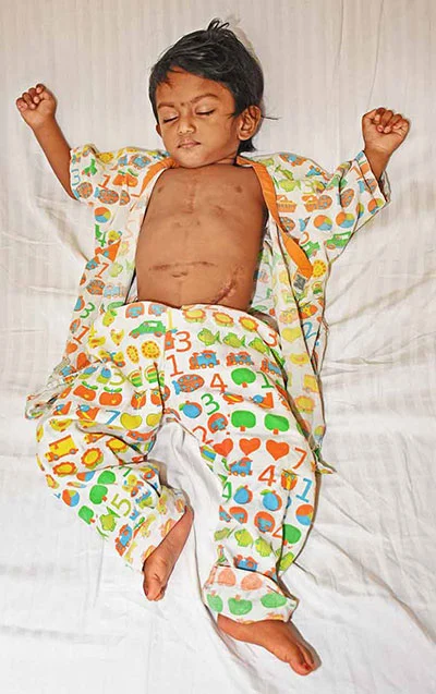 2 வயதுக் குழந்தைக்கு 3 அறுவை சிகிச்சைகள்...