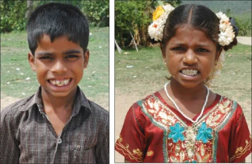 அச்சுறுத்தும் ஃப்ளுரோஸிஸ்! - சிரிப்பு முதல் சிசு வரை...