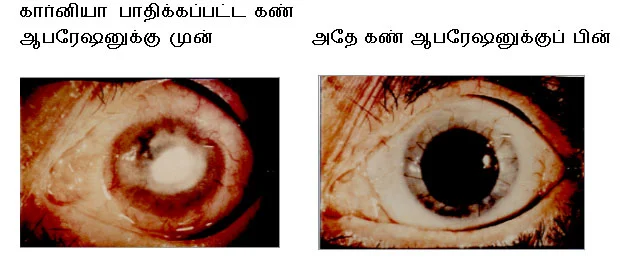 கண் தானம் - தேவை விழிப்புணர்வு !