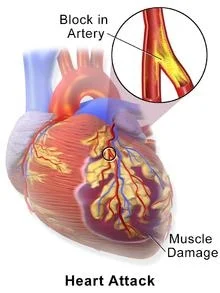 Cardiac Arrest, Heart Attack இரண்டுக்கும் என்ன வித்தியாசம்?