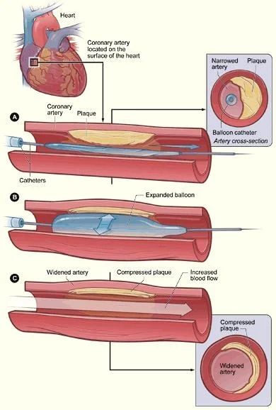 Cardiac Arrest, Heart Attack இரண்டுக்கும் என்ன வித்தியாசம்?