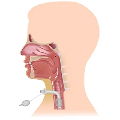 ட்ரக்கியோஸ்டோமி ஏன்? எப்படி? யாருக்கு? ஓர் அலசல்! #Tracheostomy