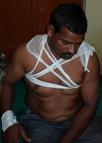 20 முறை இலங்கை கடற்படை சுட்டனர்- காயமடைந்த மீனவர் பேட்டி ( படம் )