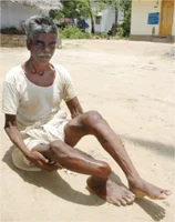 அச்சுறுத்தும் ஃப்ளுரோஸிஸ்! - சிரிப்பு முதல் சிசு வரை...