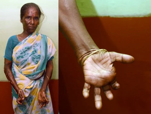 நடை பிணங்களாய் நடமாடும் பட்டாசு ஆலை தொழிலாளர்கள் - நெஞ்சை பிழியும் விருதுநகர் அவலம்