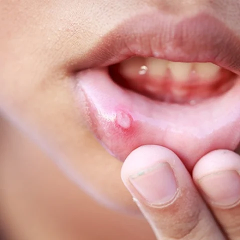 Ayurvedic measures to prevent mouth ulcers