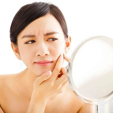 அழகைக் கெடுக்கும் முகப்பரு, தவிர்க்க சிம்பிள் டிப்ஸ்! #avoidpimples