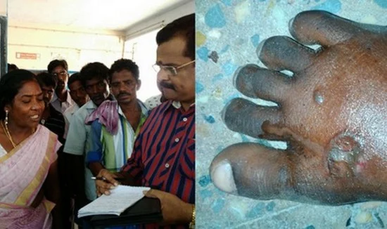 பள்ளி மாணவர்களுக்கு சூடுவைத்த ஆசிரியை கைது!