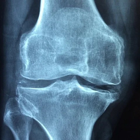 கை, கால், தொடைகளில் எலும்பு வலியா..?! அலட்சியம் வேண்டாம்! #Osteoblastoma