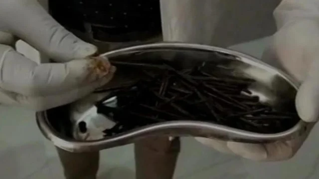 116 ஆணிகள்... இரும்புக் குண்டுகள்! - 42 வயது மனிதரின் வயிற்றுக்குள் இருந்த இரும்புக் குவியல்