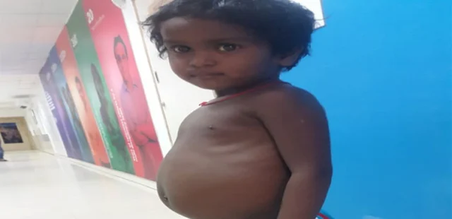 சபரீஷுக்கு இருப்பது மரபியல் கல்லீரல் நோய்!