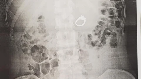 woman swallows ring