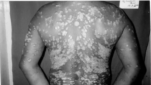 Psoriasis
