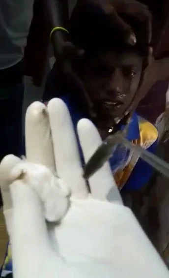 சிறுவனின் மூக்குக்குள் சென்ற சிலேபி மீன்! - லாவகமாக அகற்றிய புதுக்கோட்டை அரசு மருத்துவர்
