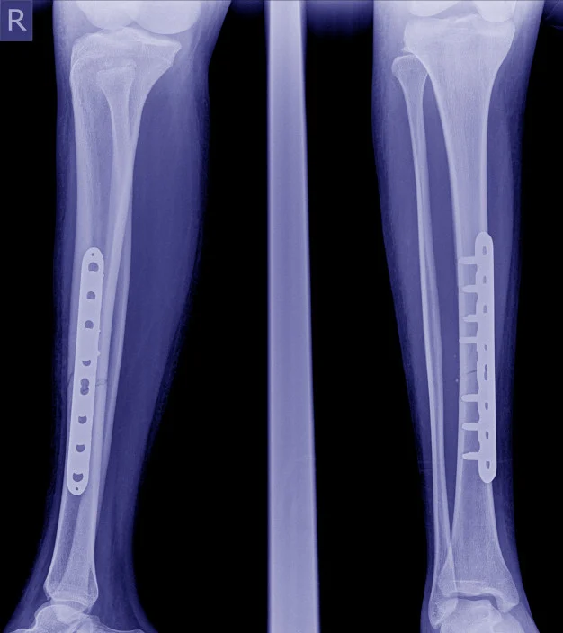 Implant