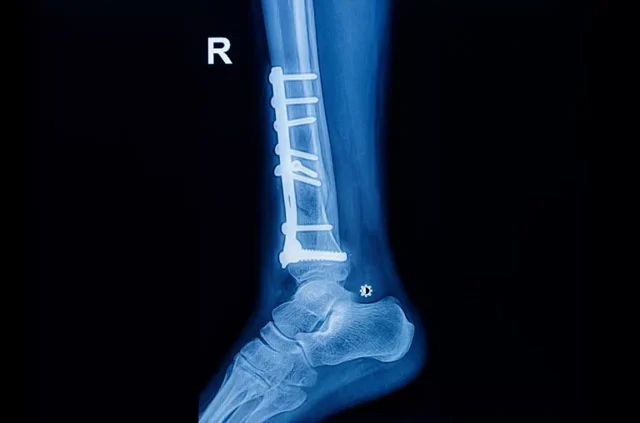 Implant Removal Surgery