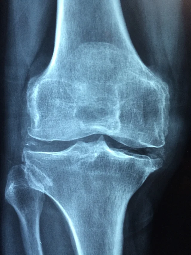 Joint pain